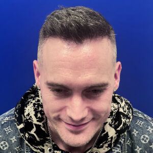 Best hair transplant chicago